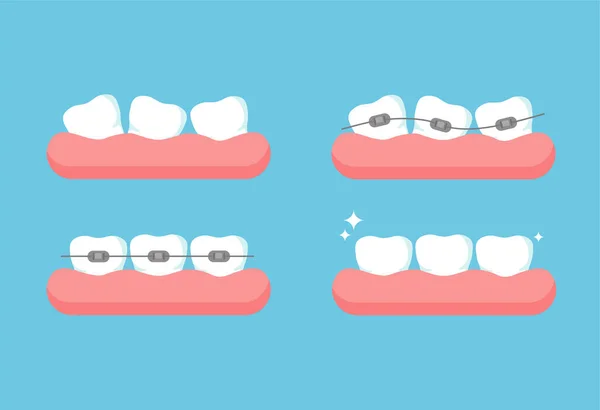 Stadien Der Kieferorthopädischen Behandlung Zähne Ohne Zahnspange Und Nach Der — Stockvektor