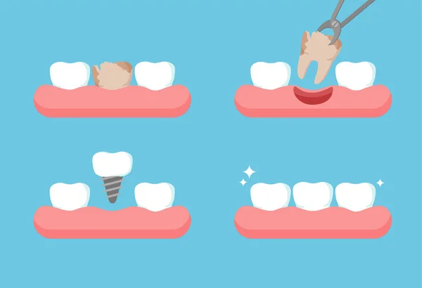 Etapas Del Tratamiento Dental Diente Extrae Con Fórceps Fila Dental — Archivo Imágenes Vectoriales