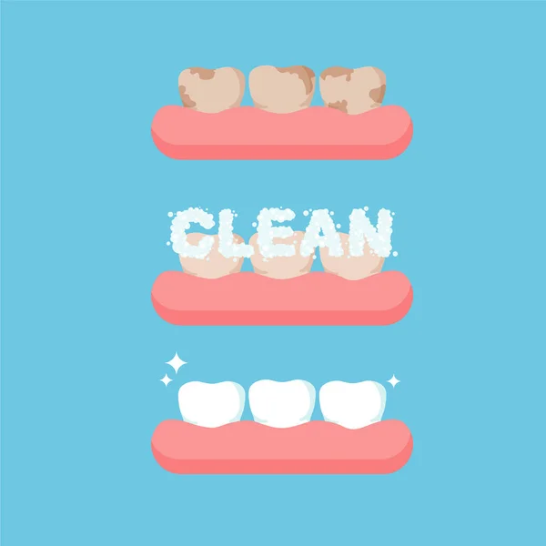歯をきれいにする 雪白と黄色の歯 白くなる前と後 歯の健康の概念 青の背景に独立したベクターイラスト — ストックベクタ