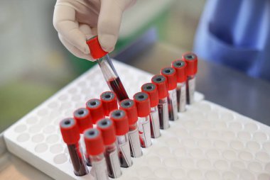 Laboratuvar teknisyeni test yapmadan önce hastanın kan tüpünü kontrol ediyor.