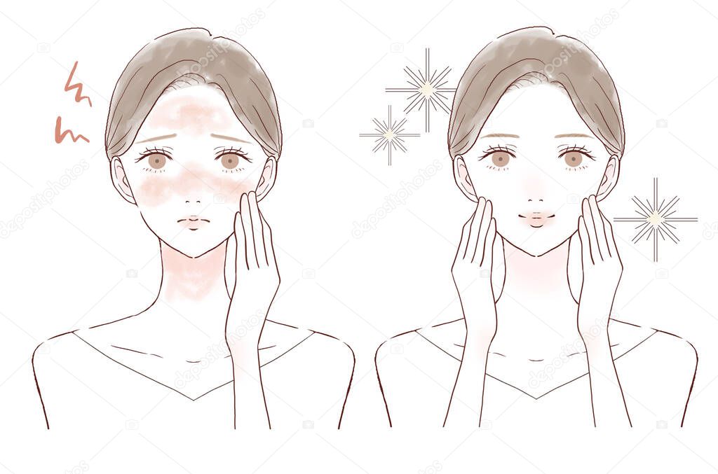 Before and after of women suffering from skin inflammation. On white background.