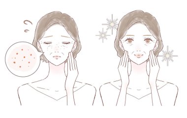 Sebum gözeneklerinden muzdarip orta yaşlı kadınların öncesi ve sonrası. Beyaz arkaplanda.