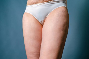 Doğumdan sonra cildinde gerilme izleri ve sarkık deri olan bir kadın. Çıplak karın ve kadının kalçaları. Deri ve vücut bakımı.