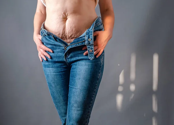 Female Body Torn Blue Jeans Naked Belly Stretch Marks Postpartum — Stock Photo, Image
