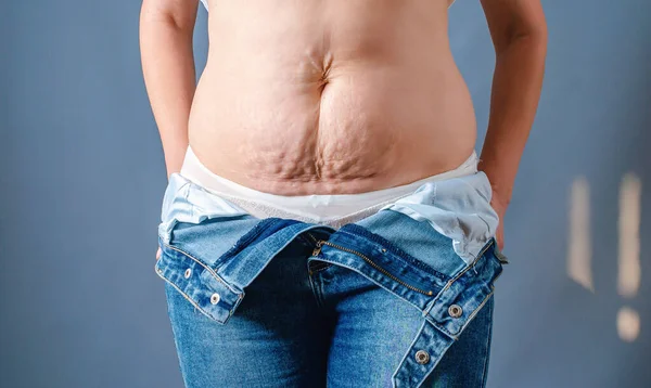 Female body with torn blue jeans. Naked belly with stretch marks. Postpartum depression