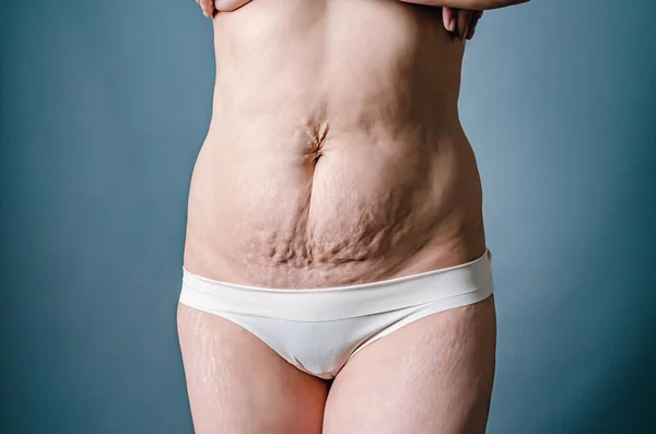 分娩后有伸展斑和松弛皮肤的妇女的前视 裸腹和女人的大腿皮肤和身体护理 — 图库照片