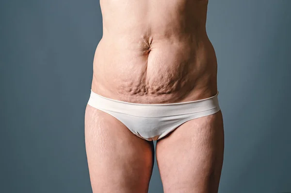 Front View Skin Woman Stretch Marks Flabby Skin Childbirth Naked — Stock Photo, Image