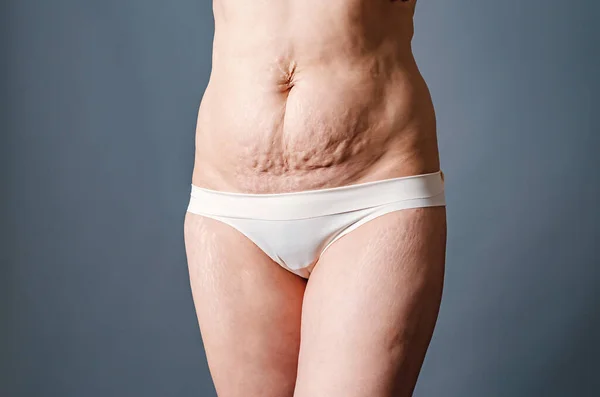 Front view of skin of woman with stretch marks and flabby skin after childbirth. Naked belly and thighs of woman. Skin and body care.