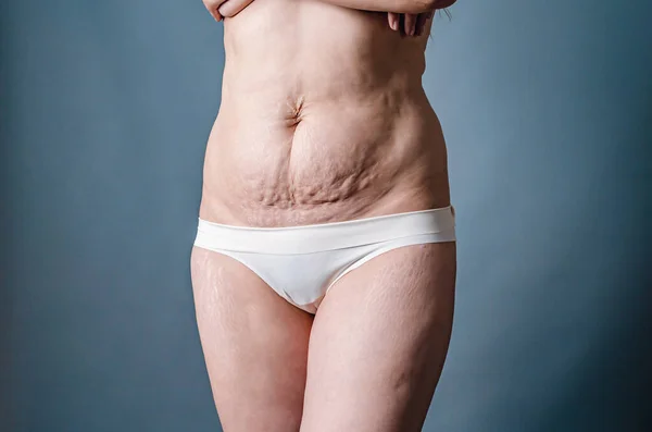 分娩后赤裸的腹部和大腿 腹部和腿部皮肤上的女性伸展痕迹 — 图库照片