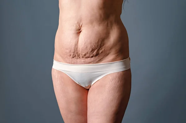 Naked belly and thighs of woman after childbirth. Female stretch marks on skin of abdomen and legs.