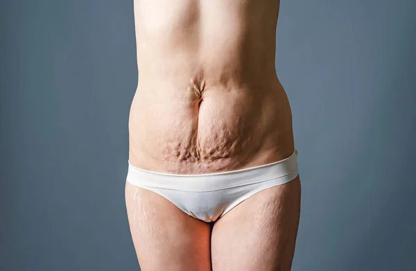 Front view of skin of woman with stretch marks and flabby skin after childbirth. Naked belly and thighs of woman. Skin and body care.