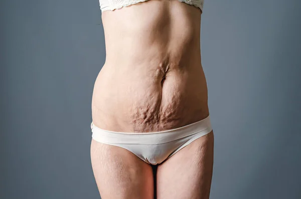 分娩后赤裸的腹部和大腿 腹部和腿皮肤上的女性伸展痕迹 侧视图 — 图库照片