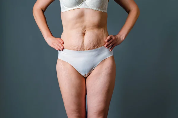 Front view of skin of woman with stretch marks and flabby skin after childbirth. Naked belly and thighs of woman. Skin and body care.