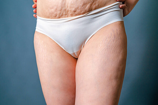 Front view of skin of woman with stretch marks and flabby skin after childbirth. Naked belly and thighs of woman. Skin and body care.