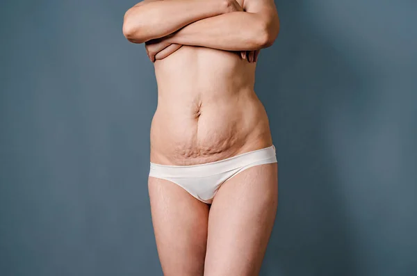 Γυμνό Γυναικείο Σώμα Λευκά Εσώρουχα Μετά Τον Τοκετό Ραγάδες Στο — Φωτογραφία Αρχείου