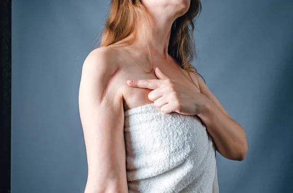 Žena Ručníku Ukazuje Jizvu Ruce Operaci Léčba Jizev Laserové Leštění — Stock fotografie