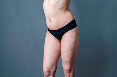 Doğumdan sonra cildinde gerilme izleri ve sarkık deri olan bir kadın. Çıplak karın ve kadının kalçaları. Deri ve vücut bakımı.