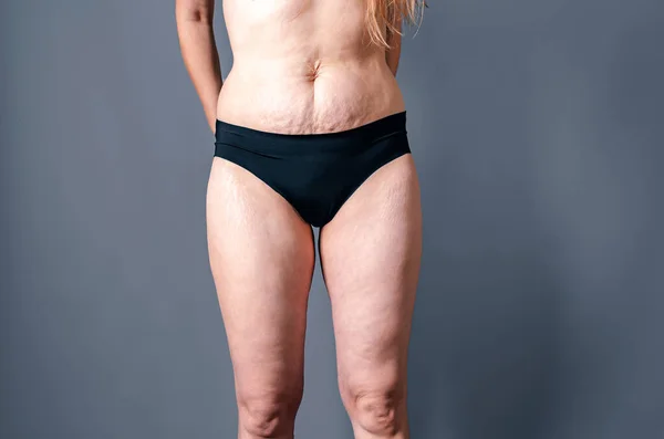 Naked belly and thighs of woman after childbirth. Female stretch marks on skin of abdomen and legs.