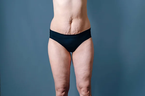 Doğumdan Sonra Çıplak Karın Kadın Kalçaları Karın Bacaklarda Kadın Gerilme — Stok fotoğraf
