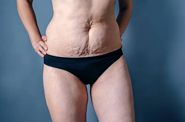 Front view of skin of woman with stretch marks and flabby skin after childbirth. Naked belly and thighs of woman. Skin and body care.