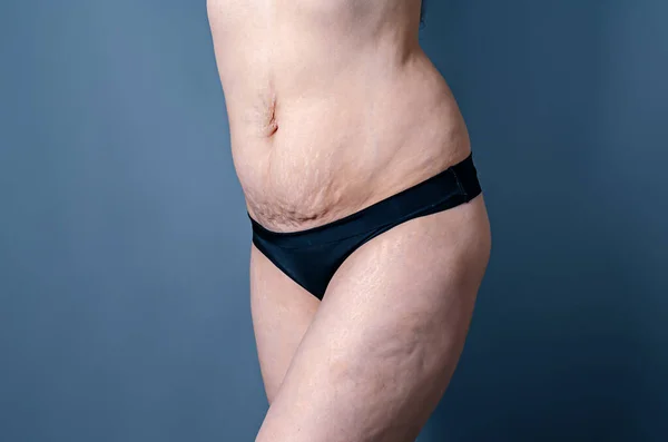 Pancia Nuda Cosce Donna Dopo Parto Smagliature Femminili Pelle Addome — Foto Stock