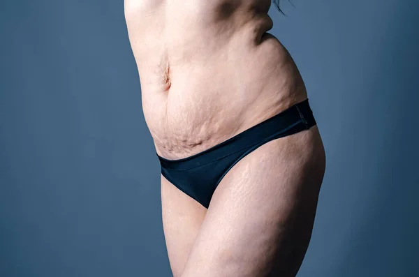 Front view of skin of woman with stretch marks and flabby skin after childbirth. Naked belly and thighs of woman. Skin and body care.