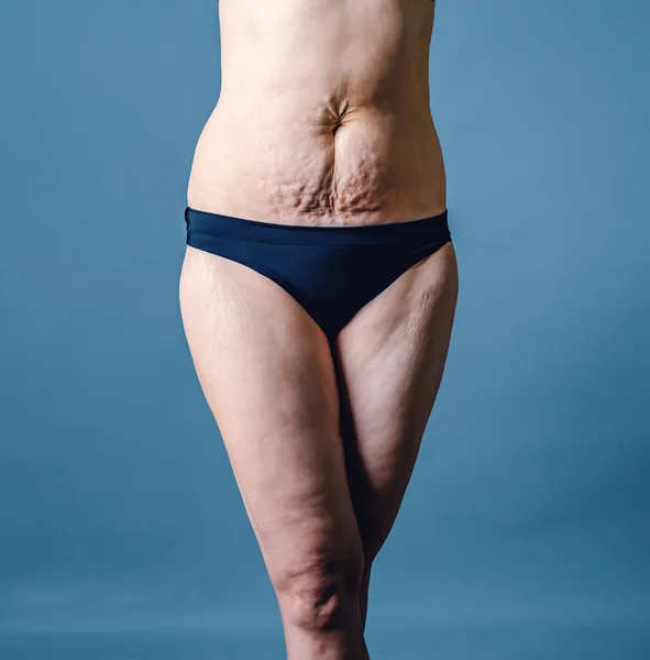 Front view of skin of woman with stretch marks and flabby skin after childbirth. Naked belly and thighs of woman. Skin and body care.