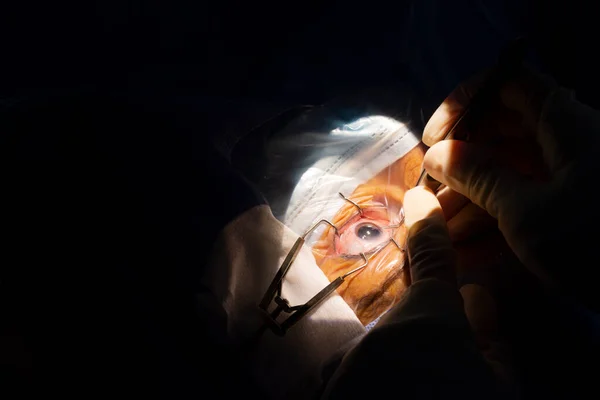 Close-up of a human eye, cataract surgery in an ophthalmology operating room. Sterile drape and surgeon's hands with sterile gloves inserting a cataract forceps into the anterior chamber of the eye.