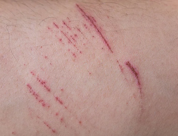 Scratches wound on the skin.