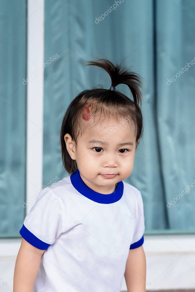 Close up of Adorable little child girl with large capillary strawberry hemangiomas red birthmark on head. Happy smiling girl, a positive female kid, looking at mother or someone. Health care concept