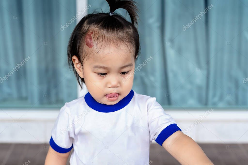 Close up of Adorable little child girl with large capillary strawberry hemangiomas red birthmark on head. Happy Asian girl, a positive female kid, looking at mother or someone. Health care concept