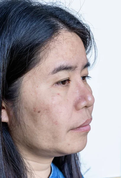 Close Van Aziatische Volwassen Vrouw Gezicht Heeft Sproeten Grote Poriën — Stockfoto