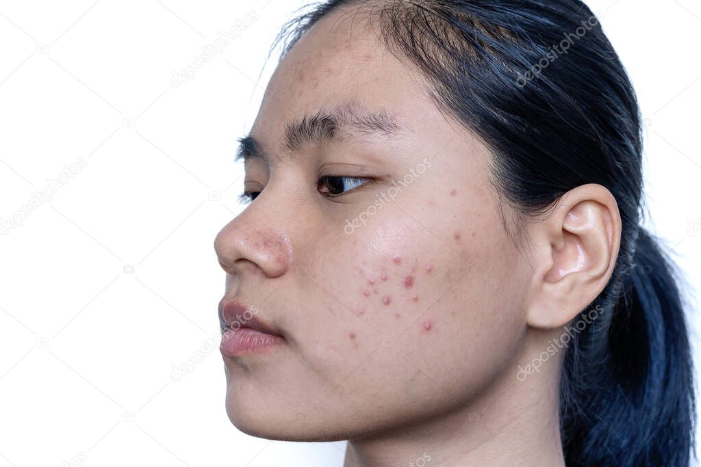 Close up of young Asian woman worry about her face when she has problems with skin on her face. Problems with acne and scar on the female skin. Problem skincare and health concept.