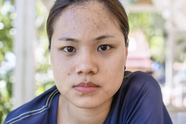 Jonge Aziatische Vrouw Zorgen Haar Gezicht Als Problemen Met Huid — Stockfoto