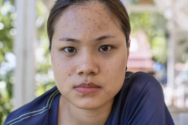 Jonge Aziatische Vrouw Zorgen Haar Gezicht Als Problemen Met Huid — Stockfoto