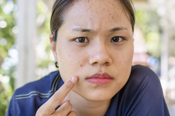 Jonge Aziatische Vrouw Zorgen Haar Gezicht Als Problemen Met Huid — Stockfoto