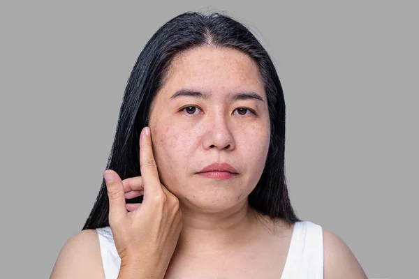 Close Asian Adult Woman Face Has Freckles Large Pores Blackhead — Stock Photo, Image