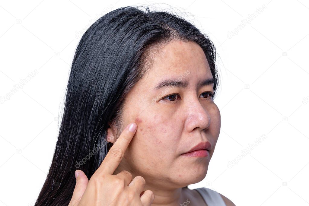 Close up of Asian adult woman face has freckles, large pores, blackhead pimple and scars problem from not take care for a long time. Soft focus of skin problem face. Treatment and Skincare concept