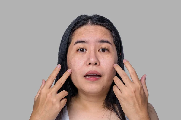 Asian Adult Woman Face Has Freckles Large Pores Blackhead Pimple — Stock Photo, Image