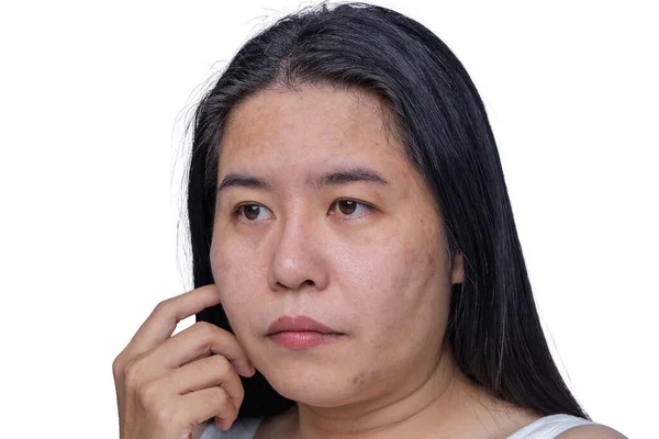 Asian Adult Woman Face Has Freckles Large Pores Blackhead Pimple — Stock Photo, Image