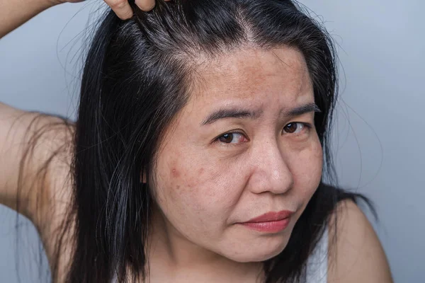 Asian Adult Woman Face Has Freckles Large Pores Blackhead Pimple — Photo