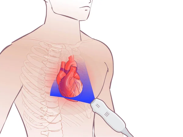 心臓超音波イラスト 心エコー図の概念段階的な配列プローブは 人の胸に配置されます — ストックベクタ