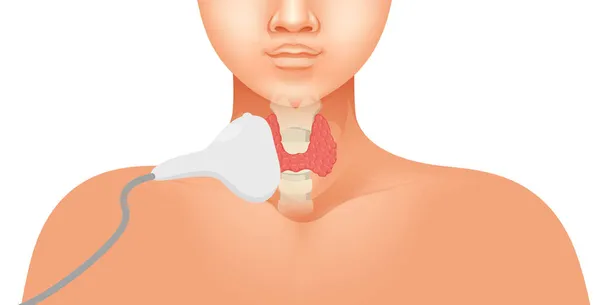 Thyroid Ultrasound Vector Illustration Linear Array Probe Placed Human Neck — Stock Vector