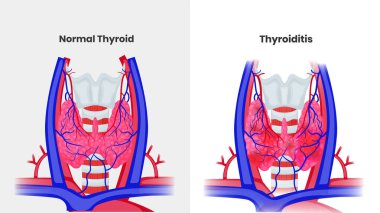 Tiroid anatomisi tiroidite karşı. Tiroid yapısının vektör çizimi ve tiroit iltihabı