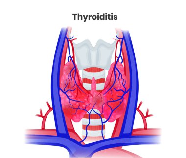 Kronik tiroidit anatomik vektör çizimi. İltihaplı tiroidin, damarların ve radyo dalgalarının çizimi