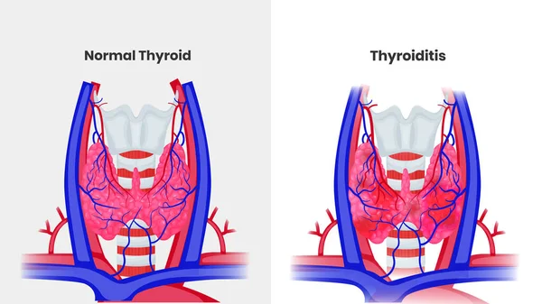 Anatomía Tiroidea Normal Tiroiditis Ilustración Vectorial Estructura Tiroidea Normal Inflamación — Vector de stock