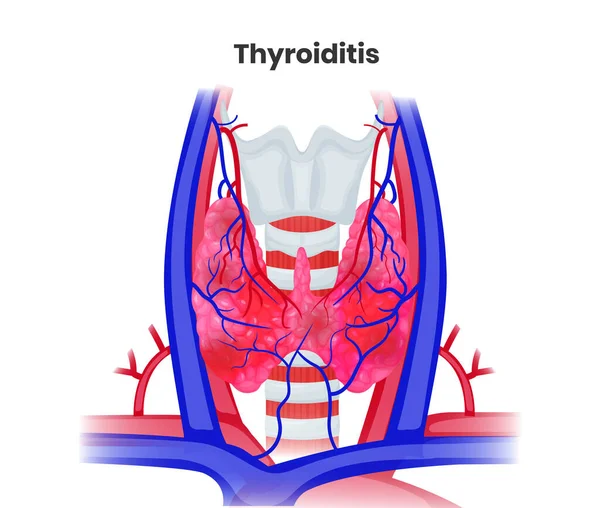 Chronische Thyreoiditis Anatomische Vektorillustration Illustration Der Entzündeten Schilddrüse Gefäße Und — Stockvektor