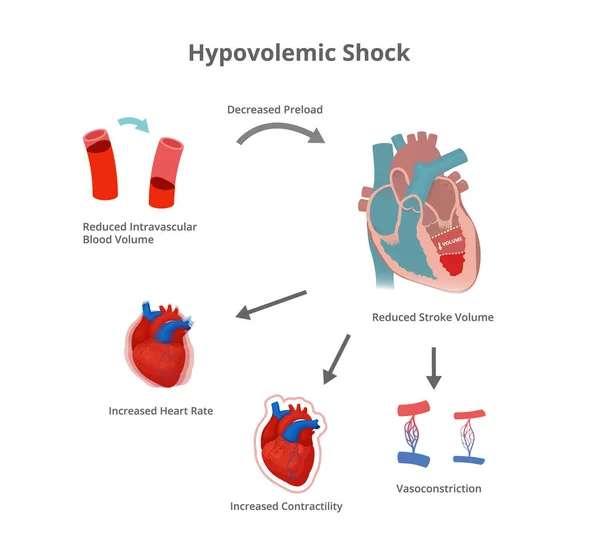 Hypovolemic Shock Pathology Compensatory Mechanisms Hypovolemic Shock — Stock Vector