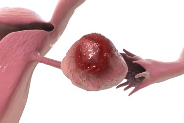 Yumurtalık kanseri, 3 boyutlu illüstrasyon sol yumurtalıkta habis tümör olduğunu gösteriyor.