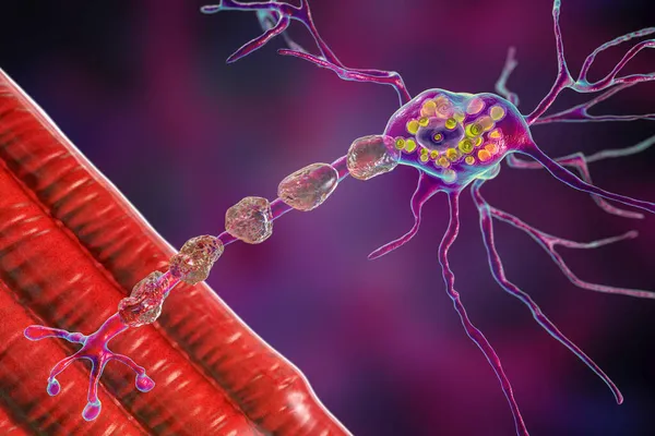 Hirnneuronen Bei Der Tay Sachs Krankheit Illustration Zeigt Geschwollene Neuronen — Stockfoto